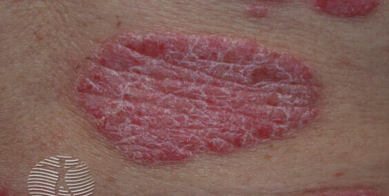 What is psoriasis: Types, Symptoms, and Treatments