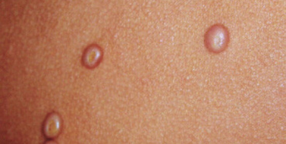 Molluscum Contagiosum (water warts): Symptoms, Causes  and Treatment