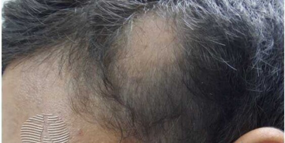 Alopecia Areata: Symptoms, Causes, Complications, Prevention, and Treatment