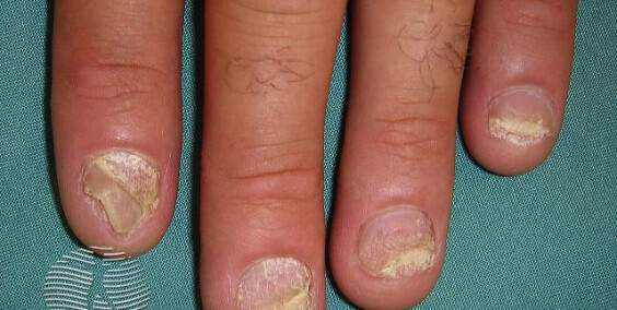 Nail Psoriasis: Symptoms, Effects, and Care