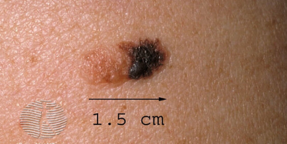 How to Recognize Cancer Moles on Skin