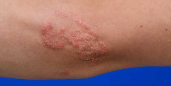 Plaque Psoriasis